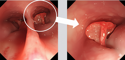 鼻腔内視鏡のイラスト