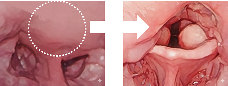 軟口蓋切除のイラスト