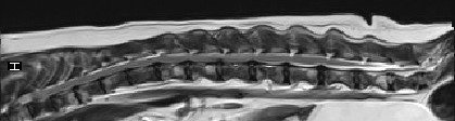 脊髄のMRI1枚目