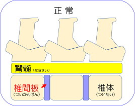 椎間板正常