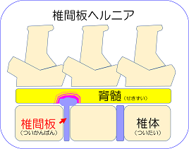 椎間板ヘルニアイラスト